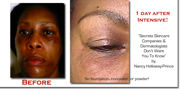 Get Rid Of Melasma